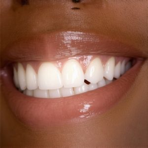 Best Cosmetic Dentistry & Crowns Tips for a Natural, Confident Smile Today