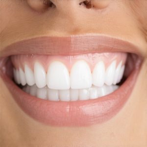 Cosmetic Dentistry Secrets: Craft a Natural, Stunning Smile with Crowns