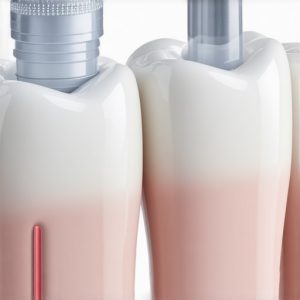 Why Your 2026 Crown Repair Needs Bio-Bonding [New Data]