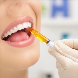 Why 2026 Family Dentists Swapped Drills for Liquid Fills