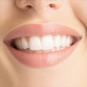 Why No-Prep Veneers Are Replacing Traditional Crowns in 2026